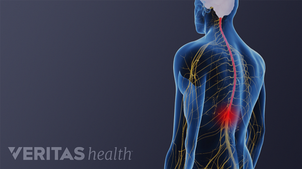 Nerves carry pain signals from a sore muscle to the brain. Percutaneous neuromodulation therapy works by blocking these pain signals and improving muscle function.