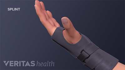 Hand with carpal tunnel braced