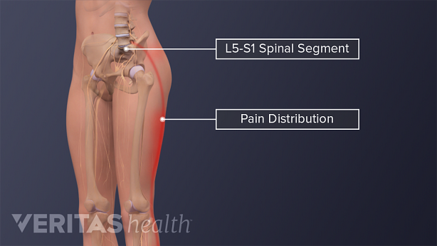 Anterior view image of lower body and skeleton with L5-S1 segment and its pain radiculopathy labeled.