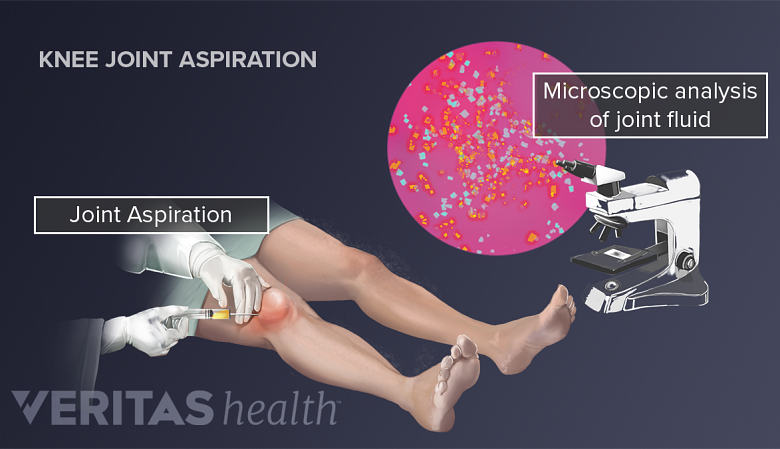 Illustration showing Joint aspiration done on a person.