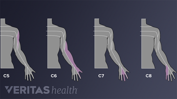 An illustration showing pain areas areas of pain distribution in the arm.
