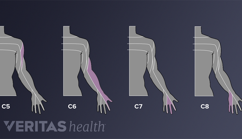 An illustration showing pain areas areas of pain distribution in the arm.