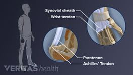 比较的Paratenon阿基里斯肌腱和腱鞘的手腕肌腱