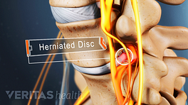 Pinched nerve vs. herniated disc: What's the difference?