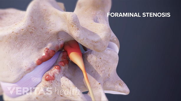 Side view 3D illustration of foraminal stenosis.
