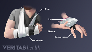 Wrist in a sling to rest and protect and someone icing wrist with compression