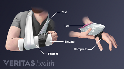 Wrist in a sling to rest and protect and someone icing wrist with compression