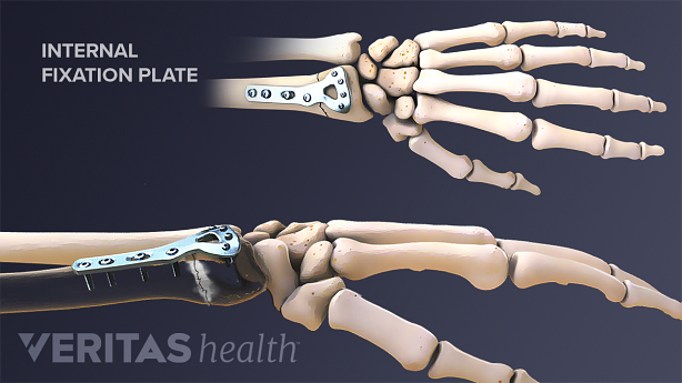 Internal fixation of a distal radius fracture