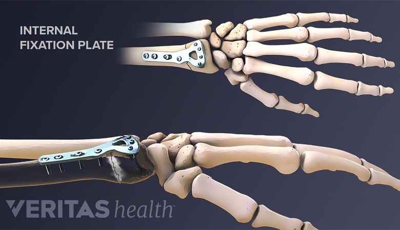 An internal fixation placed for a distal radius fracture