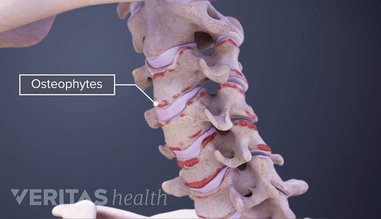 Illustration showing cervical spine with osteophytes.