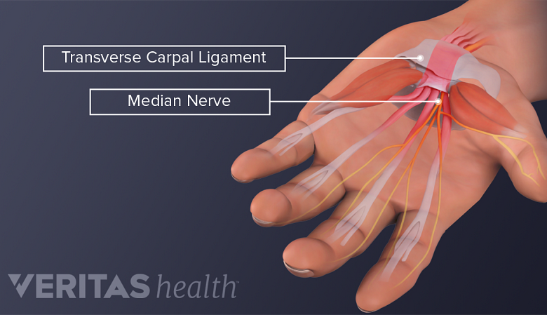 Medical illustration of the palmar view of the hand. Transverse carpal ligament, flexor tendons, and median nerve are labeled.