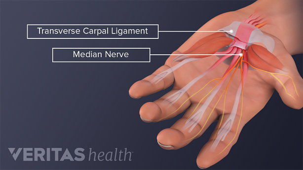 Medical illustration of the palmar view of the hand. Transverse carpal ligament, flexor tendons, and median nerve are labeled.