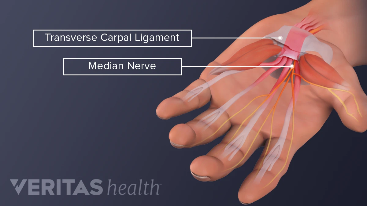 Carpal Tunnel Syndrome vs. Soft Tissue Inflammation | Sports-health Carpal Tunnel Syndrome vs. Soft Tissue Inflammation | Sports-health