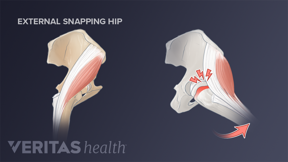 3 Types Of Snapping Hip Syndrome | Sports-health