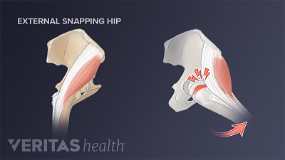 Side-by-side illustration of an external snapping hip