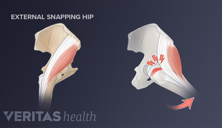 Side-by-side illustration of an external snapping hip