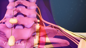Posterior view of the cervical spine showing pain in the neck.