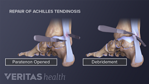 Achilles tendon repair procedure showing the incision site, paratenon opened, and debridement.