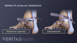 跟腱修复程序显示切口位置，腱旁打开，清创。