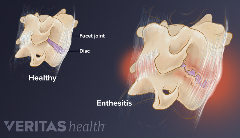 Medical illustration comparing a healthy disc to enthesitis