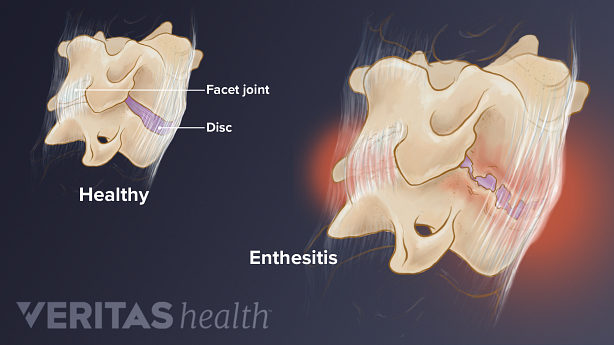 Medical illustration comparing a healthy disc to enthesitis