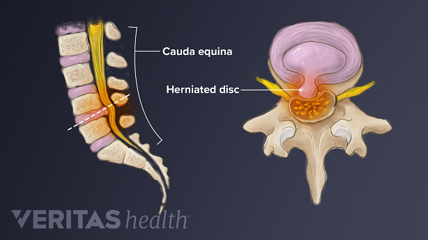 Lower spine experiencing cauda equina syndrome, with an inset showing a herniated disc.