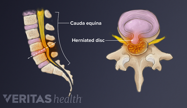 A la izquierda: una vista mediosagital de la cauda equina comprimida por una hernia de disco lumbar. A la derecha: una vista transversal superior de la misma hernia vista desde arriba.