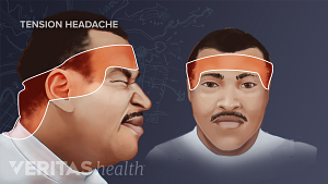 Illustration showing the swath of pain across the forehead caused by a tension headache