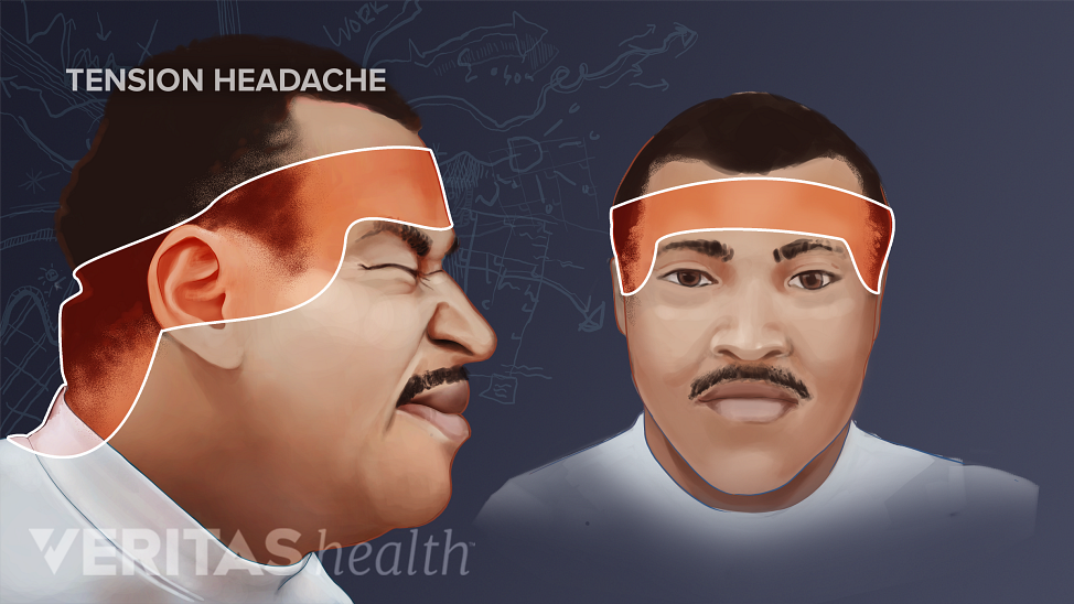 Diagram of man highlighting areas of the head and neck affected by a tension headache.