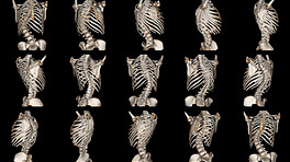 Assortment of scans detecting scoliosis in the spine.