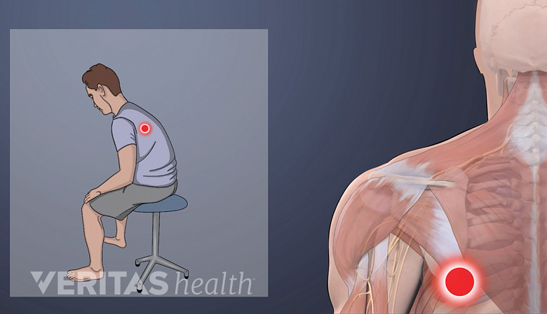 Illustration showing a man with poor posture  and a red dot near his shoulder blade.