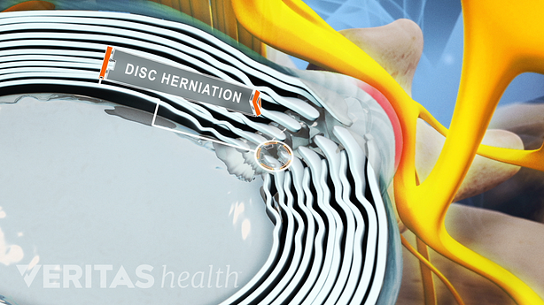 Medical illustration showing leakage from a herniated disc