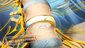 Nucleus pulposus highlighted in the disc between two vertebra
