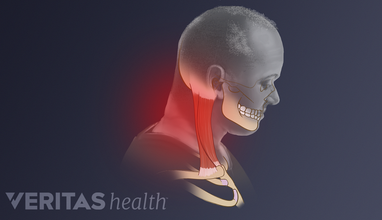 Medical illustration showing forward headtilt with red highlight in the neck region.