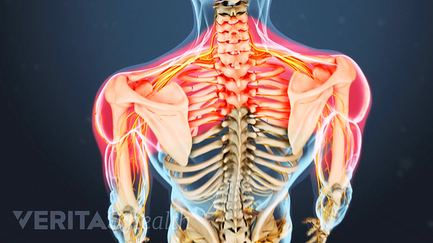Pain in the upper back caused by cervical degenerative disc disease.
