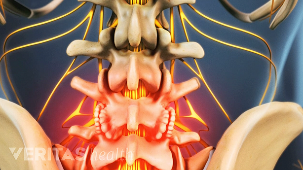 Medical illustration showing bone spurs in the lower spine caused by osteophytes