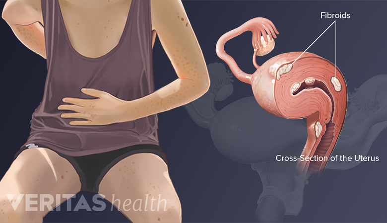 Medical illustration of fibroids
