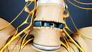 Anterior view of the lumbar store showing a cage between two vertebrae.