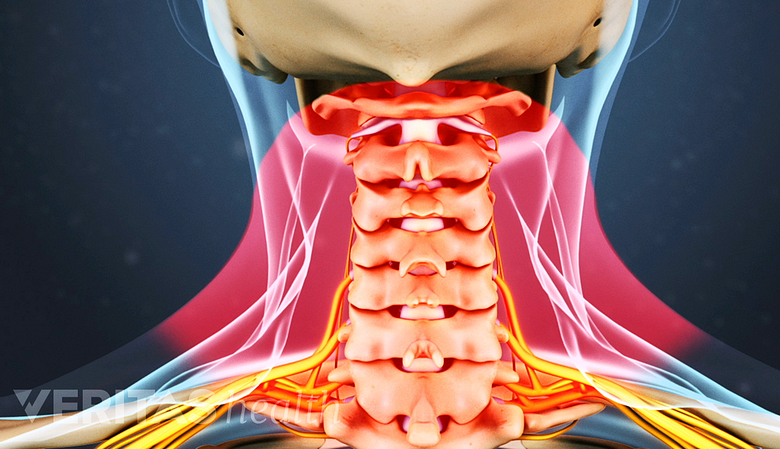 Illustratioon of cervical spine with neck area highlighted in red.