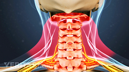 Medical illustration of the cervical spine. The muscle locations are highlighted.
