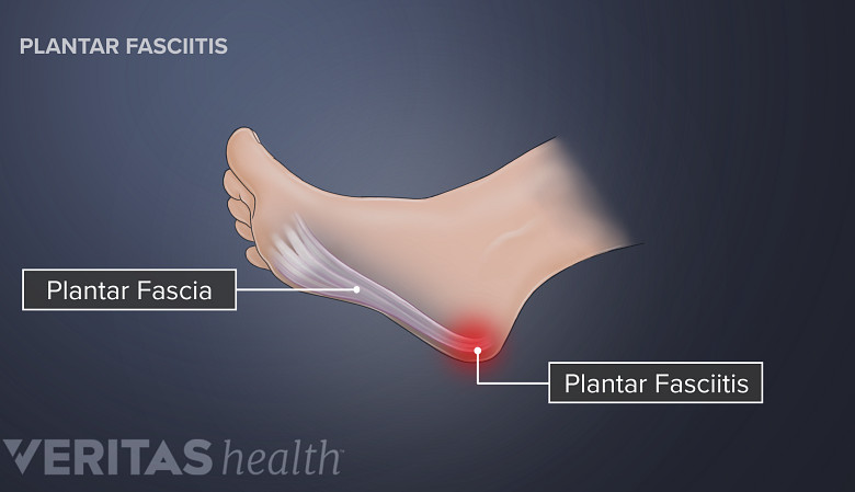 Illustration of the foot showing plantar fasciitis and plantar fascia.