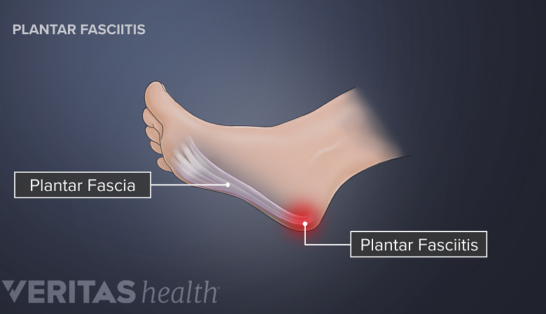 Side view of the foot labeling the plantar fascia and planter fasciitis pain.