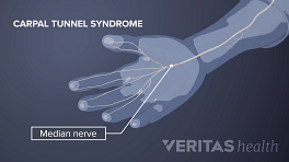 手的手掌视图显示领域的感觉由正中神经引起的。