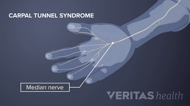 手掌视图显示由正中神经引起的感觉区域。