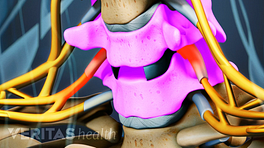 Artificial disc inserted between two highlighted vertebra