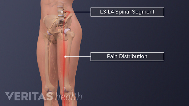 An illustration showing  pain distribution from L3 L4 spinal segment.
