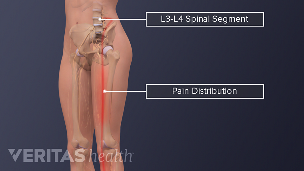 An illustration showing pain distribution from L3 L4 spinal segment.