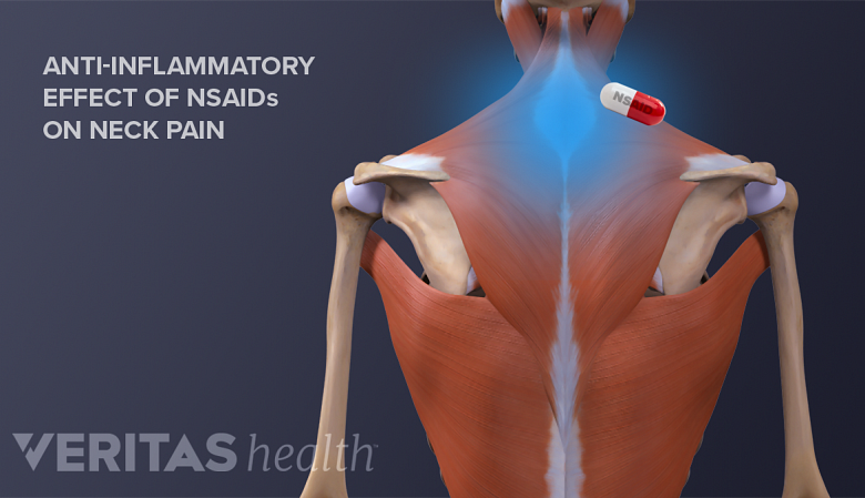 Posterior view image of back muscles and bones with an anti-inflammatory pill.