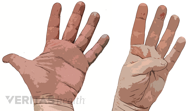 Gentle Hands Visual/ No Pinching Visual