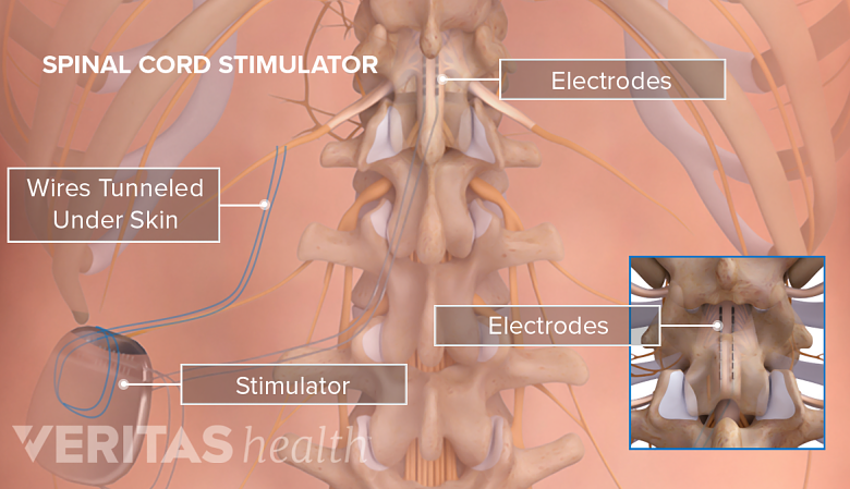 parts of spinal cord stimulator